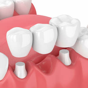 We're Boise dentists who make your bridges and dentures look just like your natural teeth.