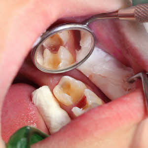 At Parkway Dental, you can depend on us to fix those painful cavities.