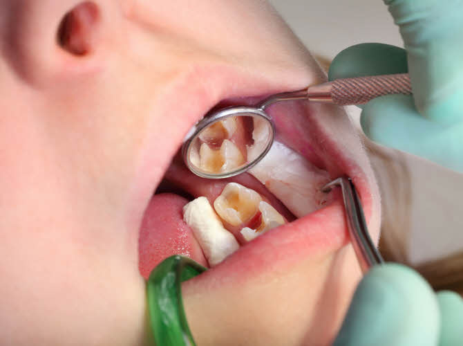 Root canals aren't fun, but our dentists are gentle experts that repair those cavities with tooth colored fillings.