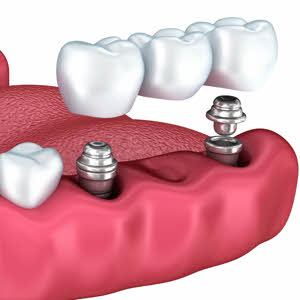 Our dentists are your best choice in Boise for dental implants, call for a consultation today.