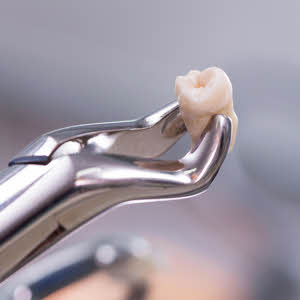 If your wisdom teeth need to be removed or other teeth need to be surgically extracted, we're dentists in Boise and Eagle who have the gentle touch you need.
