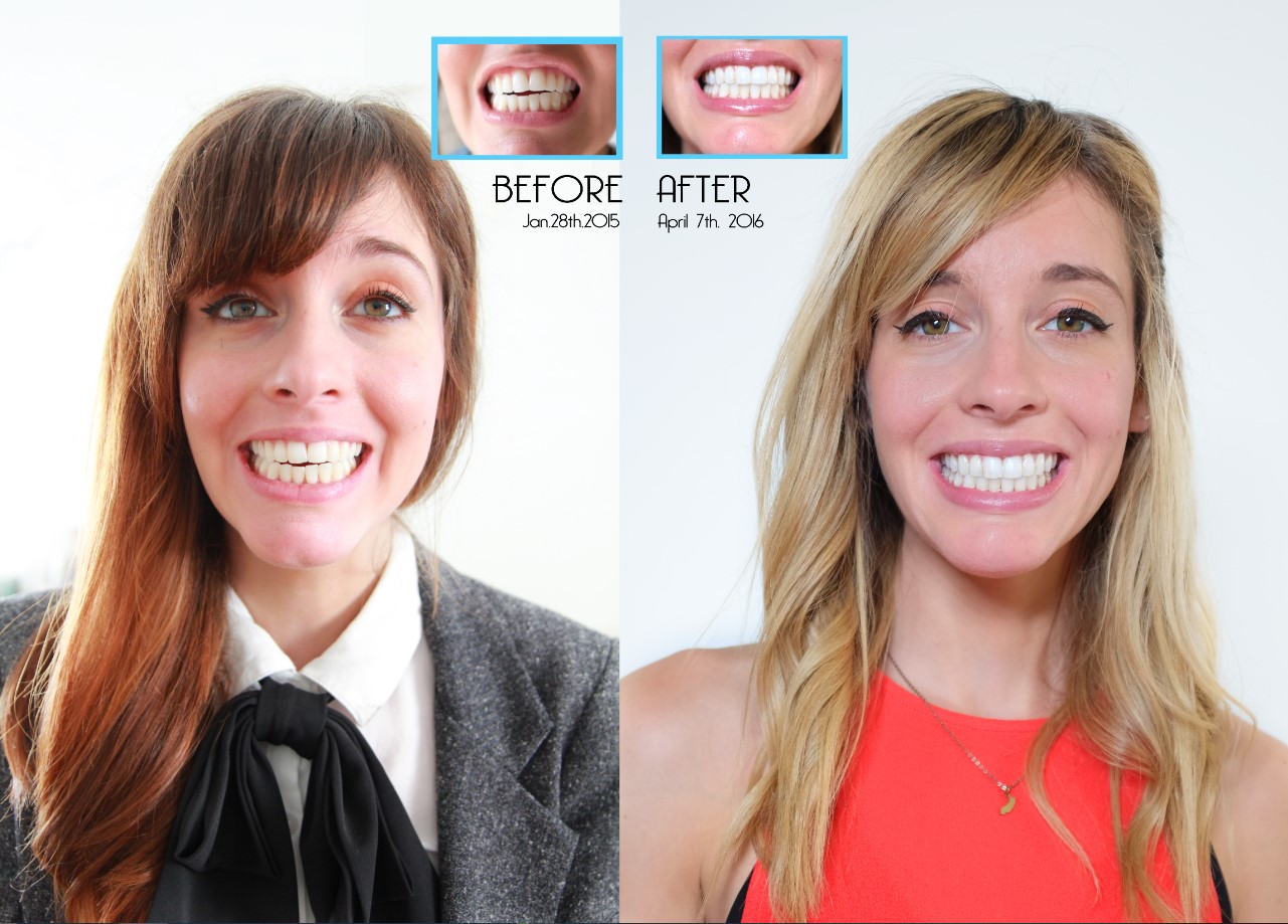 Invisalign Before After