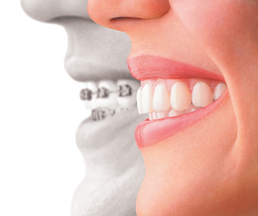 Invisalign vs Braces