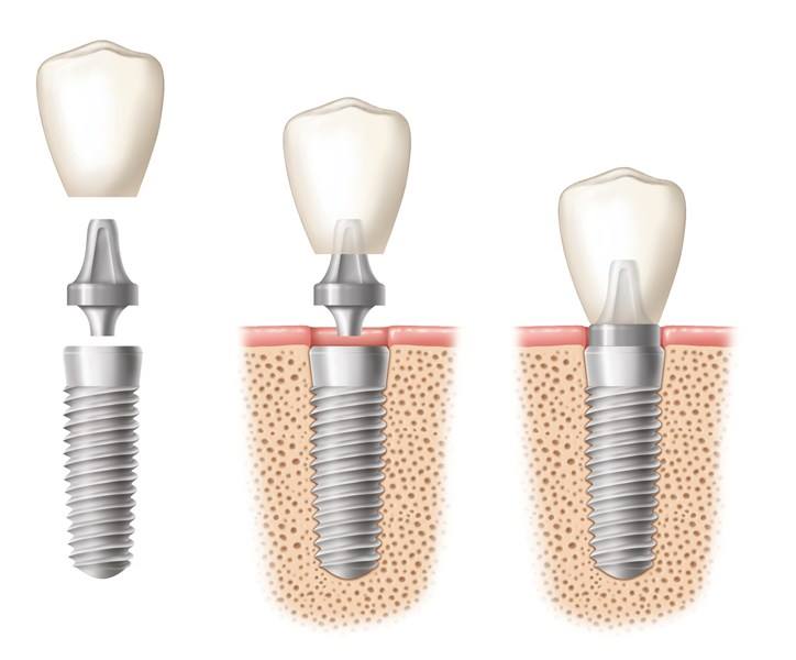 Implant Parts