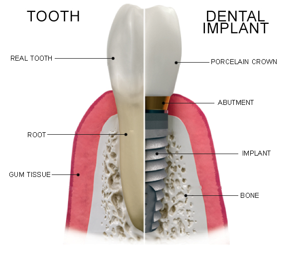 Dental Implant